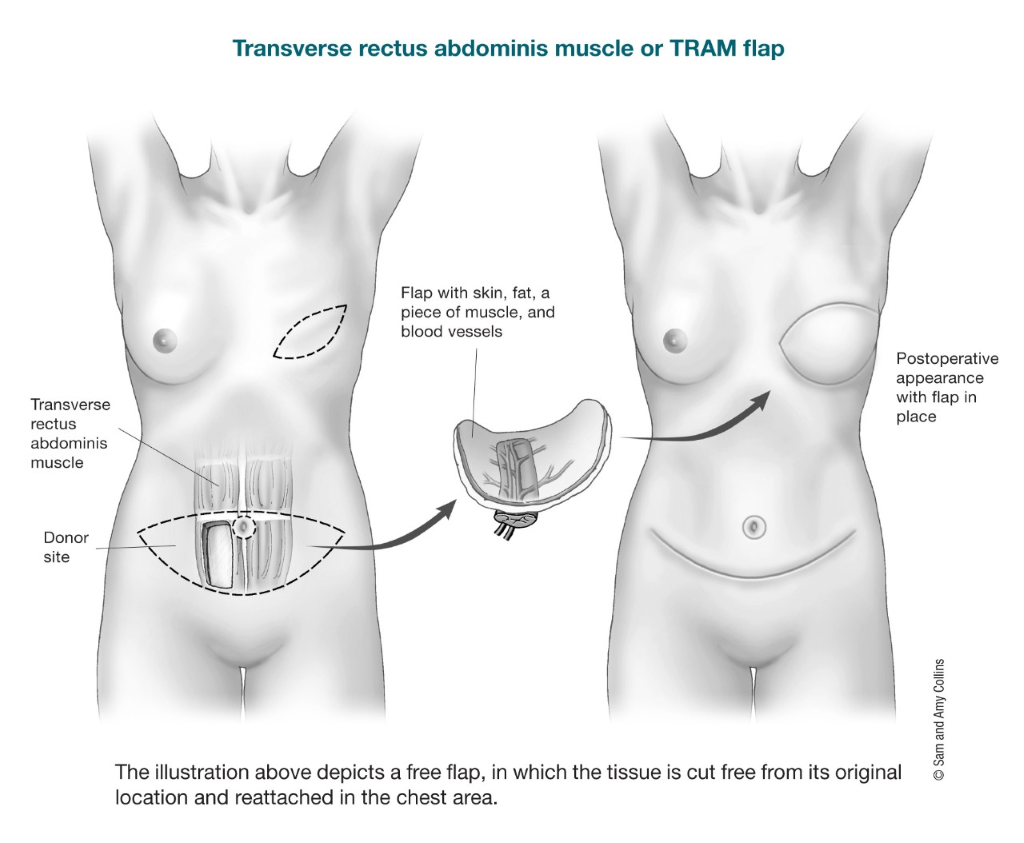 Breast Implant Position: Above or Below the Muscle? - Imagine